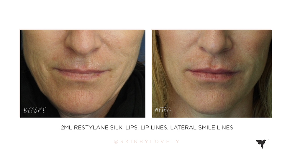 dermal filler in lip lines before and after in santa monica