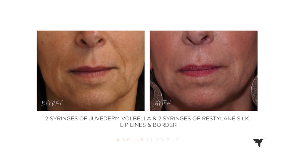 juvederm volbella and restylane silk lip lines and border before and after