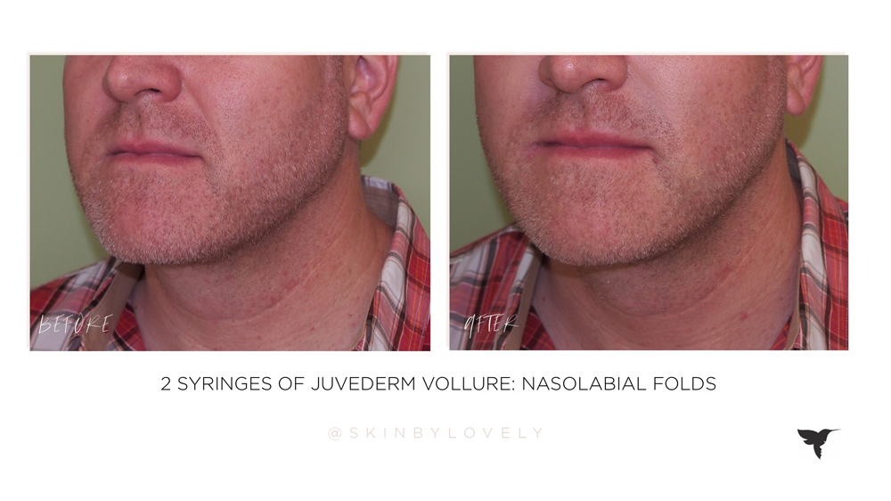 juvederm vollure dermal filler in nasolabial folds before and after