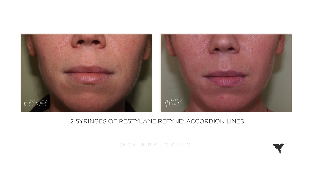 restylane refyne before and after for accordion lines