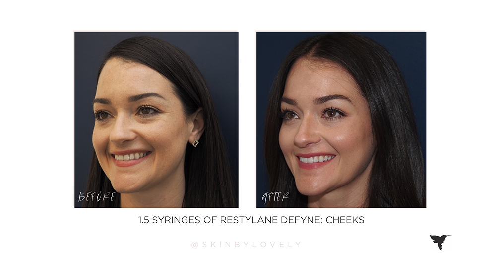 restlyane defyne dermal filler in cheeks before and after in santa monica