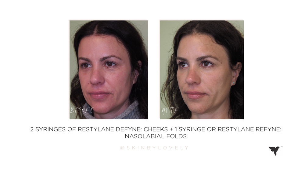restylane refyne and defyne before and afters in cheeks