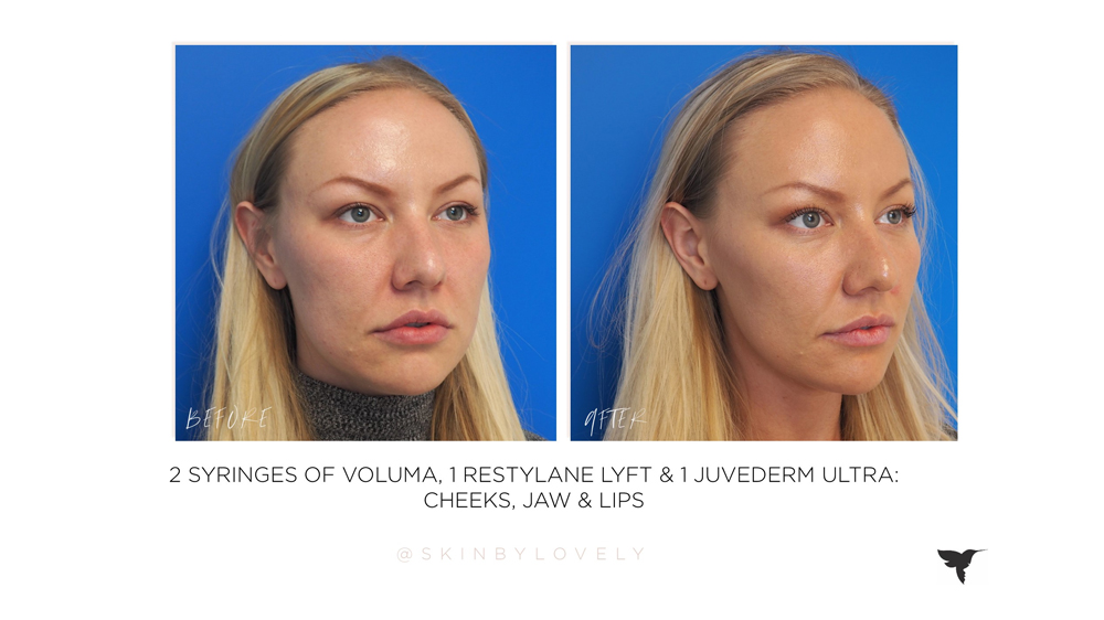 juvederm voluma, restylane lyft and juvederm ultra in cheeks, jaw and lips before and after