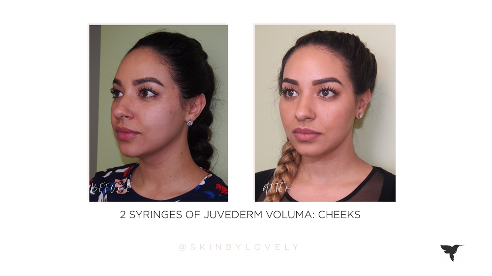 Juvederm Voluma in cheeks before and after in portland, lake oswego, santa monica