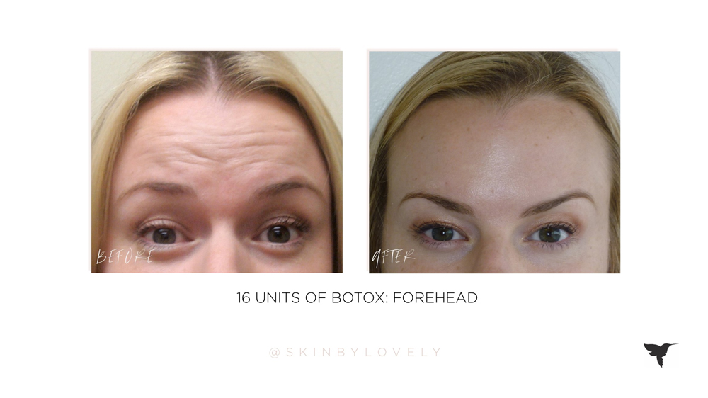 Botox in forehead before and after in santa monica, portland and lake oswego