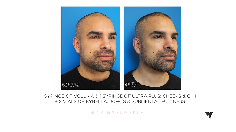 Dermal Filler Before and after, kybella before and after kybella results, kybella lake oswego, filler lake oswego , kybella portland, filler for men, botox for men