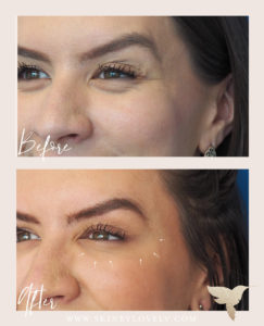 Under-eye tear trough and crow's feet before and after with dermal filler and Botox