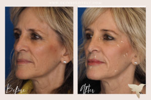 Contouring with Dermal Fillers, Before and Afters with Cheeks, Cheek Dermal Filler