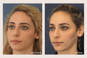 Contouring with Dermal Fillers, Before and Afters with Cheeks, Cheek Dermal Filler