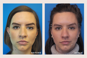 Contouring with Dermal Fillers, Before and Afters with Cheeks, Cheek Dermal Filler