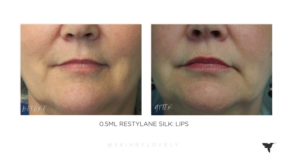 Lip filler before and after, Skin by Lovely Lake Oswego