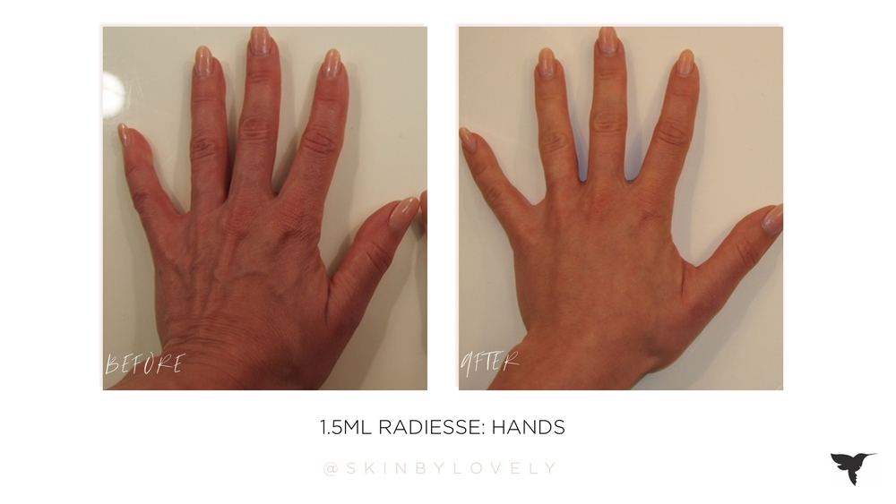 radiesse in hands before and after in santa monica