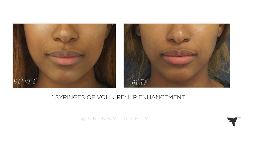 Lip filler before and after, Skin by Lovely Santa Monica