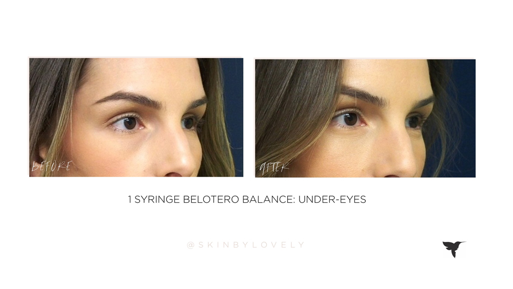 Under eye filler before and after, Skin by Lovely, Beloterp