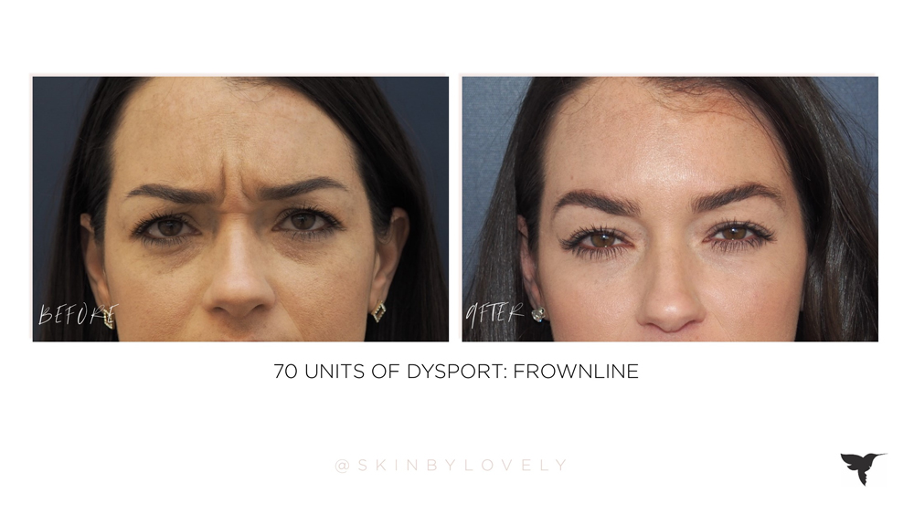 dysport in frown lines before and after