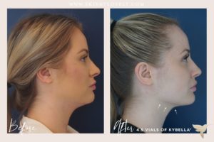 Kybella before and after in Santa Monica CA