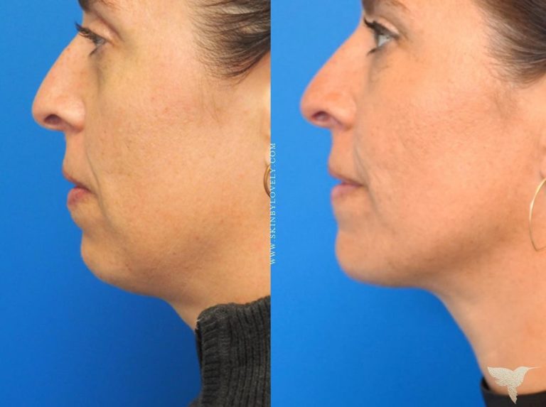 Before and after of jawline and chin dermal filler