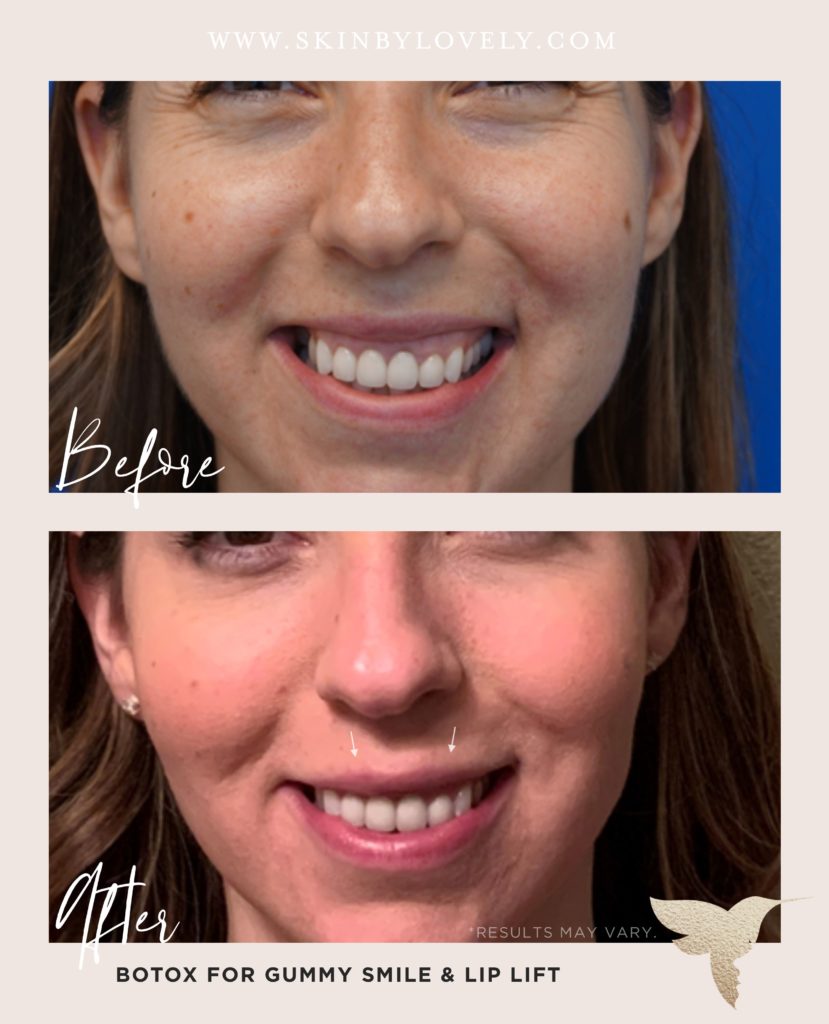 Lip flip before and after with Botox 