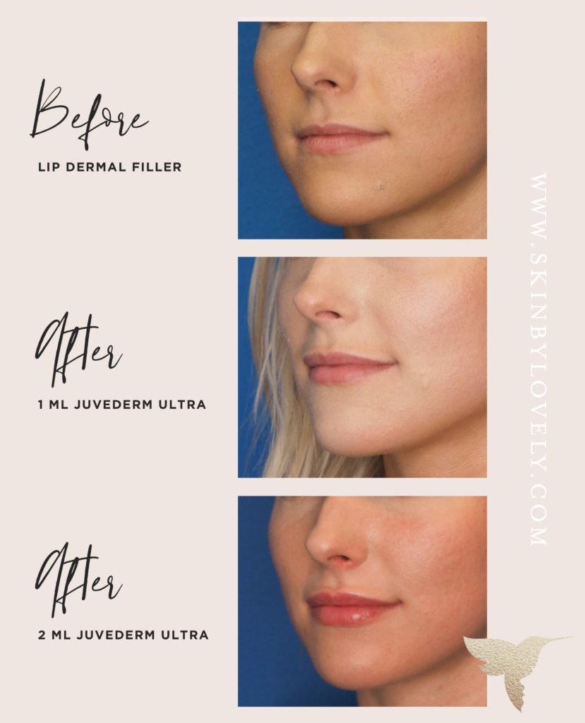 Lip filler before and after with Juvederm ultra