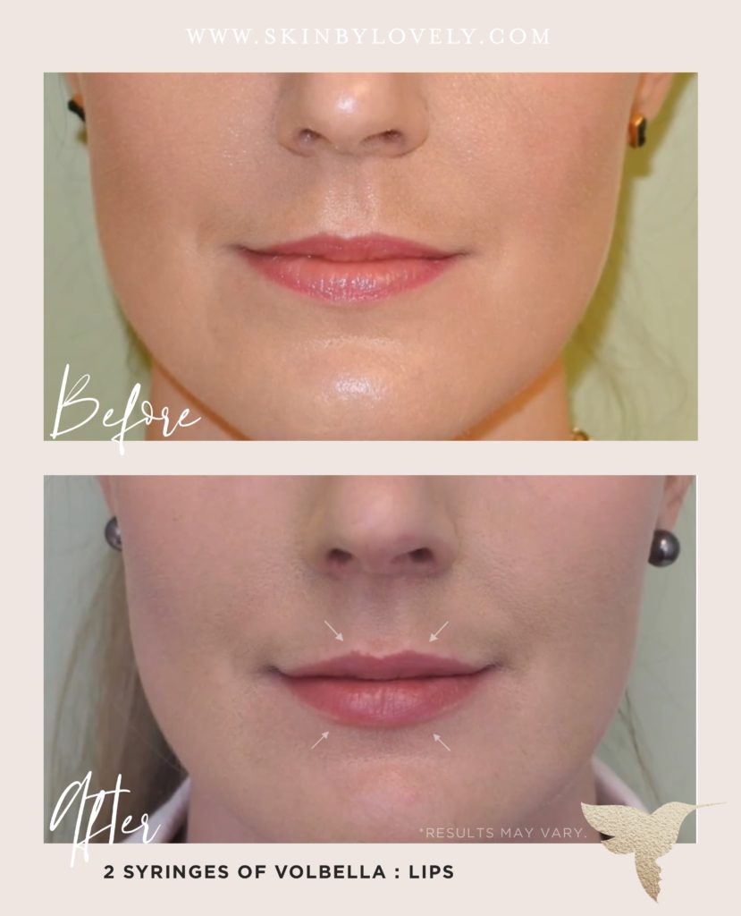 Lip filler before and after with Volbella