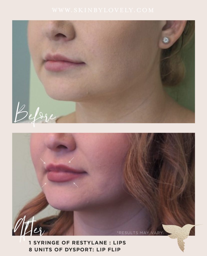 lip filler and lip flip before and after with Restylane