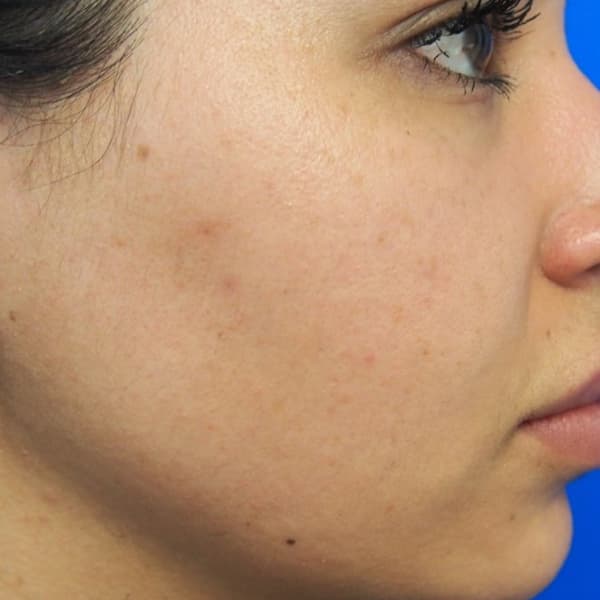 Microneedling After