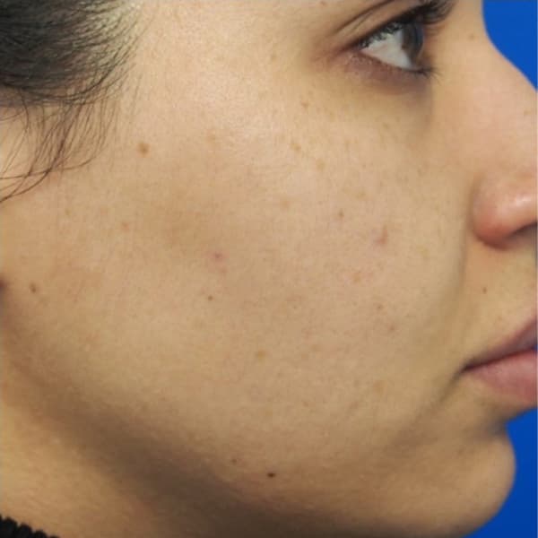 Microneedling Before