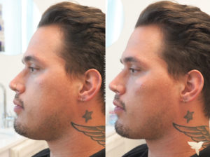 Restylane Contour before and after