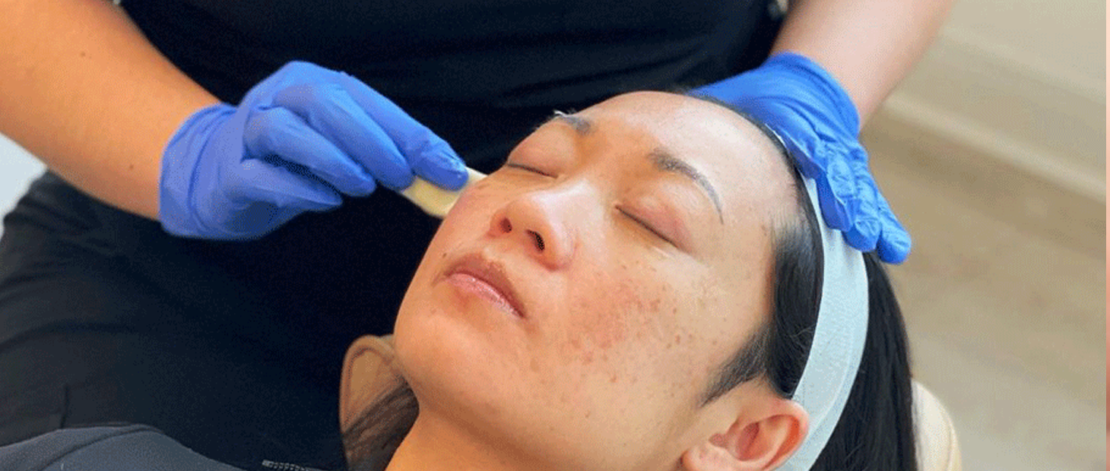 Chemical peel treatment at Skin by Lovely in Portland