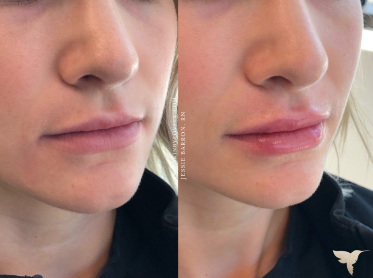 Lip Filler Before and After with Jessie Barron
