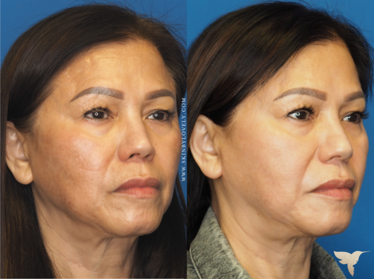 Cosmelan Depigmentation Peel Before and After in Los Angeles CA