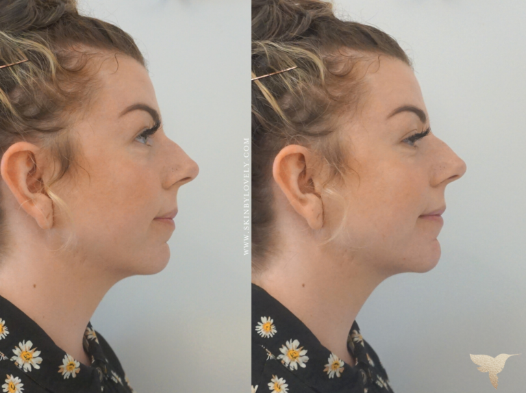 Chin Filler Before and After at Skin by Lovely Portland & Santa Monica