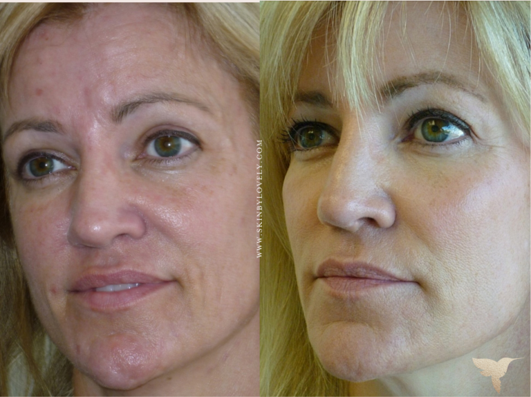 Cheeks and Tear Trough Before and After with Radiesse