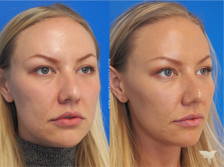Cheeks, Jaw & Lips Dermal Filler Before and After from Skin by Lovely with Voluma and Lyft