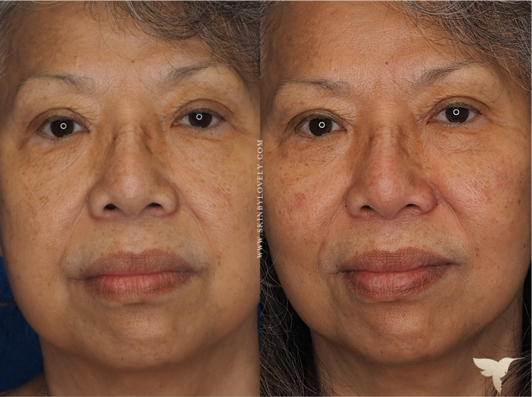 Cheek and nasolabial folds treated with dermal fillers before and after