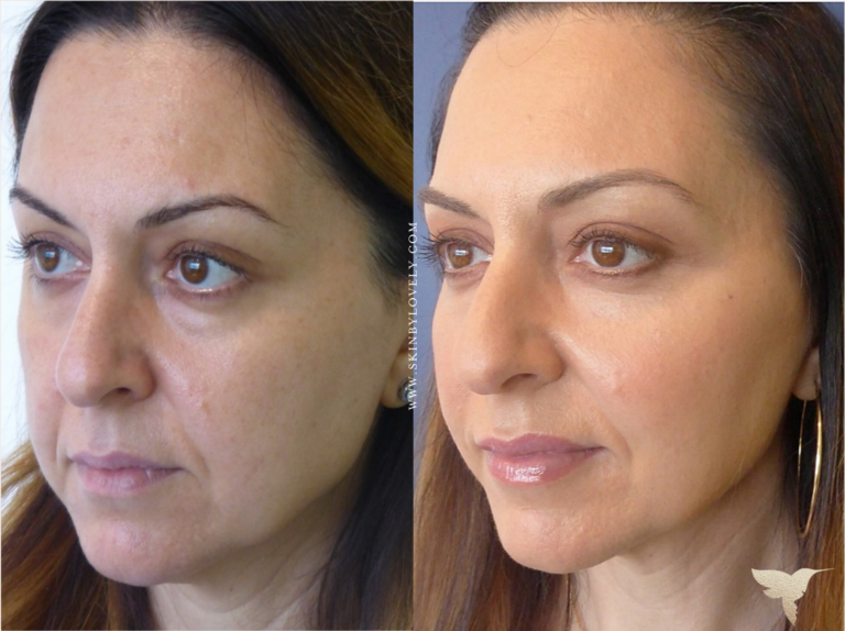 Cheeks, Tear Troughs and Lips Dermal Filler Before and after