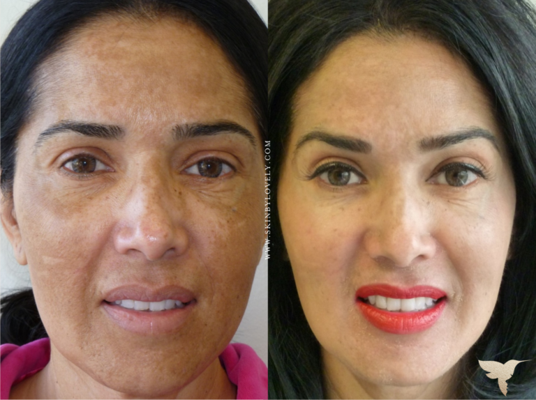 Cosmelan Depigmentation Peel Skin by Lovely Los Angeles, California