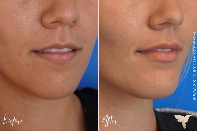 Juvederm® Volbella™ XC Before and After Skin by Lovely