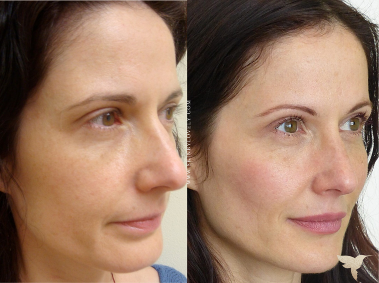 Lip and Voluma Cheek Filler Before and After from Santa Monica, California