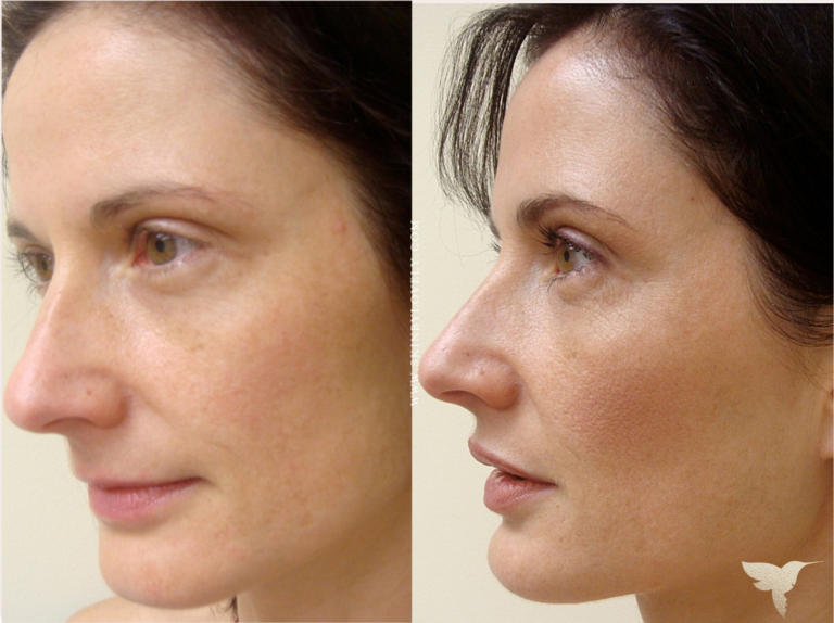 Lip and Voluma Cheek Filler Before and After from Santa Monica, California