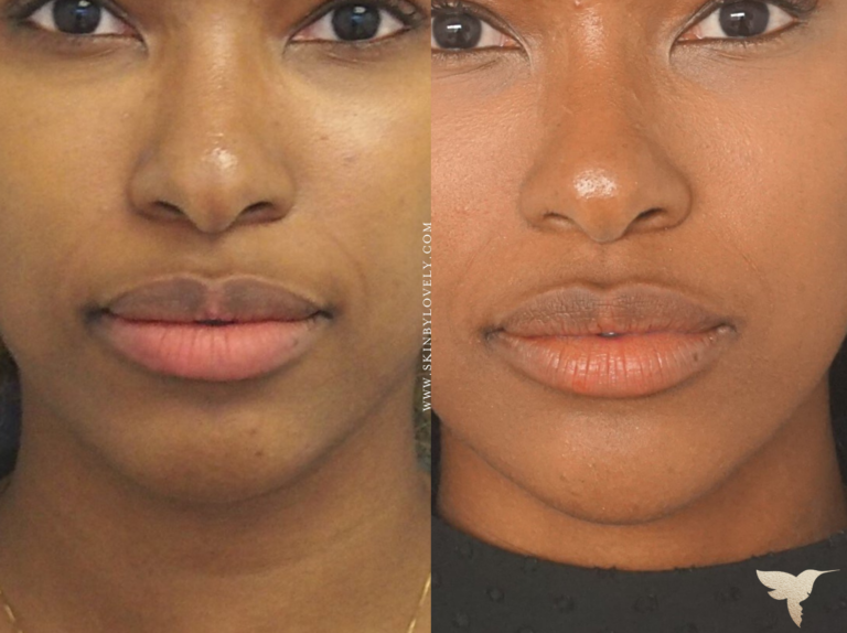 Juvederm Vollure Filler Before and After from Santa Monica, California