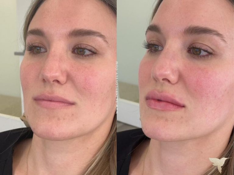 Restylane Kysse lip before and after in Los Angeles CA