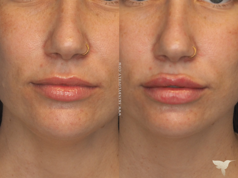 Lip Filler Before and After at Skin by Lovely Portland & Santa Monica