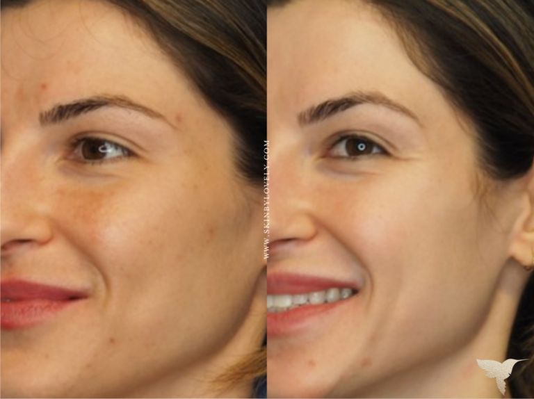 Cosmelan Depigmentation Peel Before and After