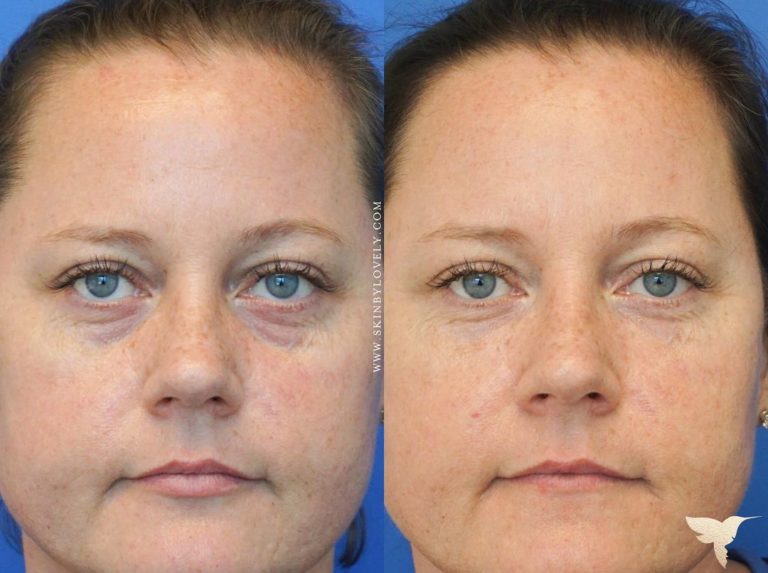 Before and after of under-eye dermal fillers in Portland, Oregon
