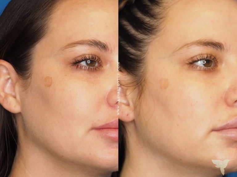 VI Peel Precision Plus before & after at Skin by Lovely Santa Monica