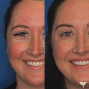 Preventative Botox before and after 