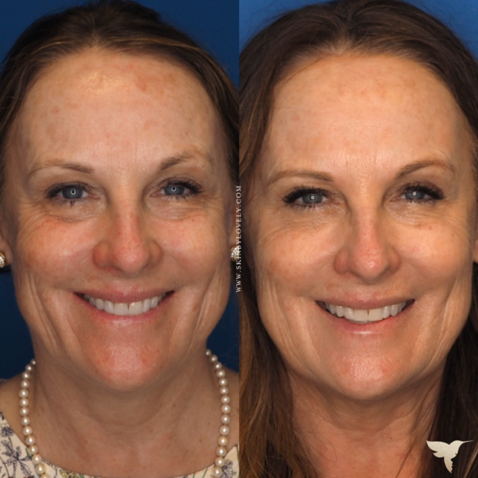 Full-Face Rejuvenation using Dermal Fillers and Botox before and after