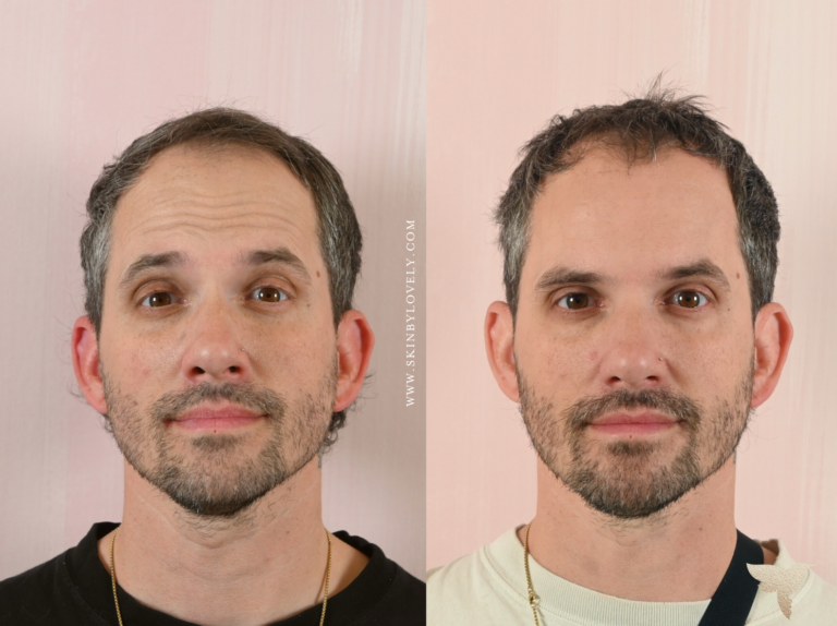 Dysport wrinkle relaxer before and after on a a male