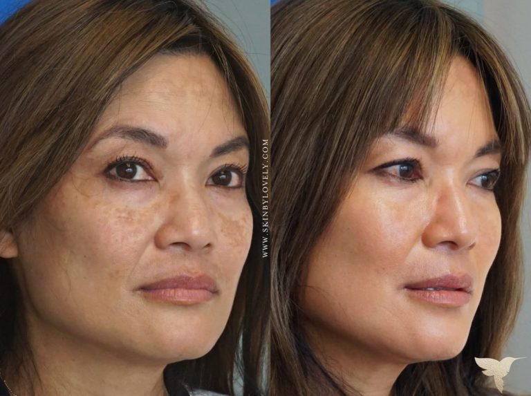 Cosmelan Depigmentation Chemical Peel Before and After Skin by Lovely in Santa Monica, CA